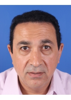 After Hair Transplant&nbsp;Front